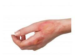
      
      Light therapy may accelerate healing of burns: Study
      
      
