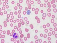 
      
      Study focuses on new treatment possibilities for young women...
      
      