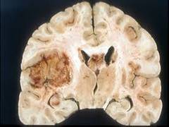 
      
      Imaging technique could enable surgeons to see and remove...
      
      
