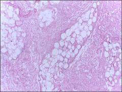 
      
      Researchers find a new method to identify aggressive breast cancer
      
      
