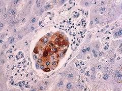 
      
      Researchers discover four hallmarks of cancer metastasis
      
      