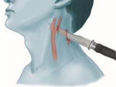 
      
      Apollo Doctors' unique adaption technique saves precious life...
      
      