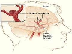 
      
      Surgeons use robot to fix brain aneurysms
      
      