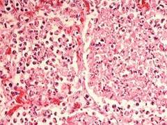 
      
      Study reveals risk factors for carrying pneumonia-causing bacteria
      
      