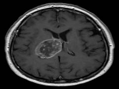 
      
      Study highlights importance of routinely imaging brain tumour...
      
      