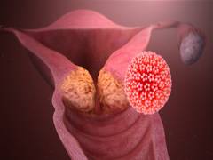 
      
      Cervical cancer survival may improve by targeting senescent...
      
      