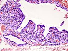 
      
      Improved treatment for patients with hyperthyroidism: Study
      
      