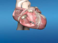 
      
      Medtronic launches Micra™ AV, world's smallest...
      
      
