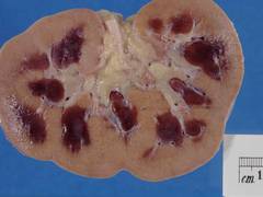 
      
      Doctors reveal new model predicting kidney injury post common...
      
      