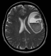 
      
      Elderly cancer survivors face risk of brain metastasis: Study
      
      