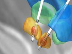 
    Non-invasive technique to treat Parkinson's disease
    