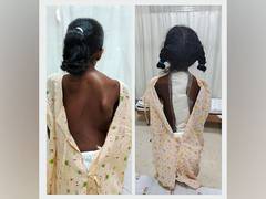 
      
      Rela Hospital performs rare spine surgery
      
      