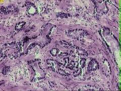 
    An accurate, noninvasive urine test for prostate cancer!
    