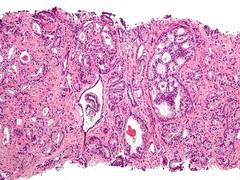 
      
      Men choose active surveillance for early age prostate cancer...
      
      
