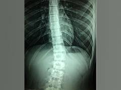 
      
      Over 5 million Chinese students suffer from Scoliosisi
      
      