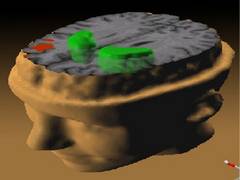 
      
      Researchers find a new approach to treat schizophrenia
      
      