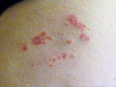 
    Sustained exposure to chickenpox reduces risk of shingles in adults
    