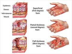 
      
      Researchers print skin cells on serious burns using 'handheld...
      
      