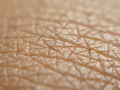 
      
      Study reveals half of lupus rashes harbour high levels of...
      
      