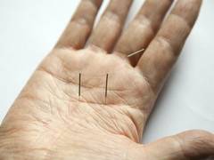 
      
      Study reveals acupuncture can reduce migraine headaches
      
      