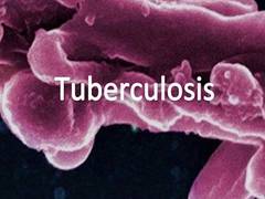 
      
      Novel tuberculosis regimen shortens treatment course for patients
      
      