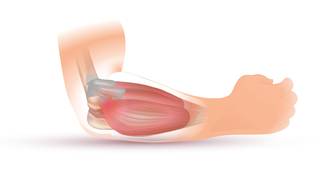 
      
      New treatment for 'tennis elbow' reduces pain, inflammation...
      
      