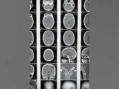 
      
       Study: Cells that results in neuronal death 
      
      