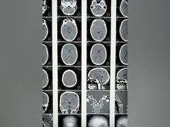 
      
      New injectable gel shows potential for tough-to-treat tumour
      
      