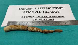 
      
      World's largest ureteric stone removed by surgery in Delhi
      
      