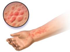 
      
      Vitamin D lessens symptoms of severe eczema in children
      
      