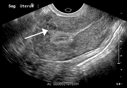 
      
      Uterine fibroid embolisation safe and as effective as...
      
      