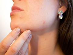 
      
      Here's how appearance of acne scars can improve!
      
      