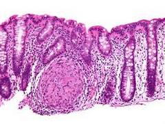 
      
      Study reveals important genetic mechanism behind inflammatory...
      
      