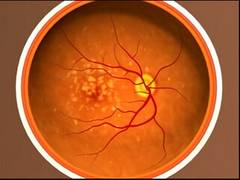 
      
      Healthy diet may lower eye disease risk: Study
      
      