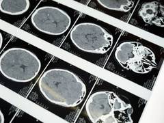 
      
      Preventing long-term effects of traumatic brain injury: Study
      
      