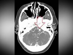 
      
      Cancer drug could be repurposed to treat brain aneurysms
      
      