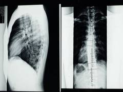 
      
      Researchers find immediate angiography may reduce stroke...
      
      