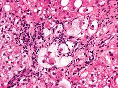 
      
      Study reveals protein SIRT6 protects against fatty liver,...
      
      