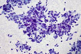 
      
      Changes in genes contribute to breast, ovarian cancer: Study
      
      