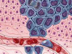 
      
      Study shows counting cells may find how cancer spreads
      
      