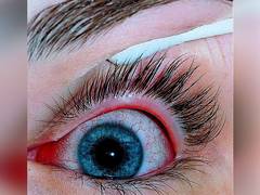 
      
      Antibody-based eye drop may treat dry eye disease: Study
      
      