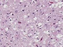 
      
      Researchers find new potential treatment for prion diseases
      
      