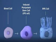 
      
      Radical treatment of oral infection is not necessary before...
      
      
