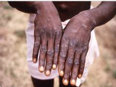 
      
      India reports third case of Monkeypox in Kerala
      
      