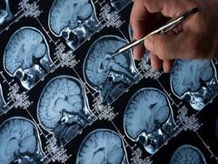 
      
      Genetic risk scores can aid accurate diagnosis of epilepsy: Study
      
      