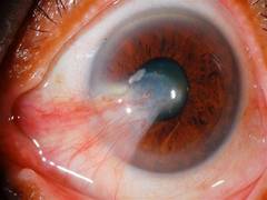 
      
      Vehicle exhaust pollutants may lead to common eye condition
      
      