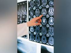 
      
      Researchers find novel approach to prevent seizures
      
      