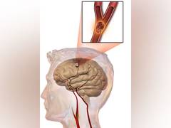 
      
      Women less likely to be diagnosed with minor strokes: study
      
      