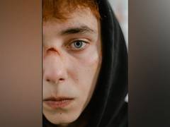 
      
      People with facial scars rate their own appearance worse than...
      
      