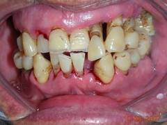 
      
      Poor oral health may increase liver cancer risk
      
      